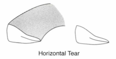 Featured image of post Meniscus White And Red Zone - Now, a tear can heal on its own with time or through a surgery if it in the in &#039;red zone&#039;.