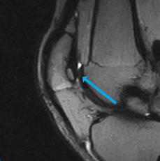 sagittal t2