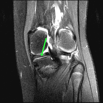 coronal t2 spir