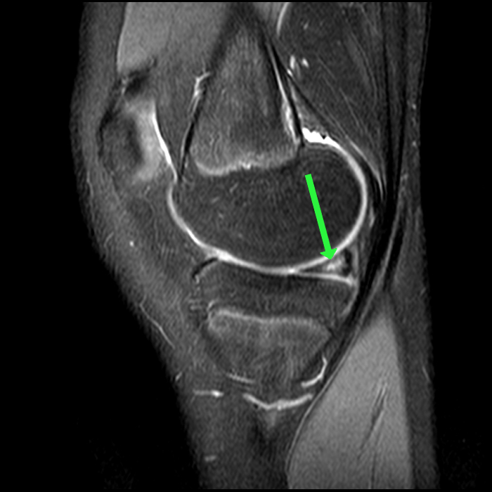 Horizontal Meniscal Tear - ProScan Education