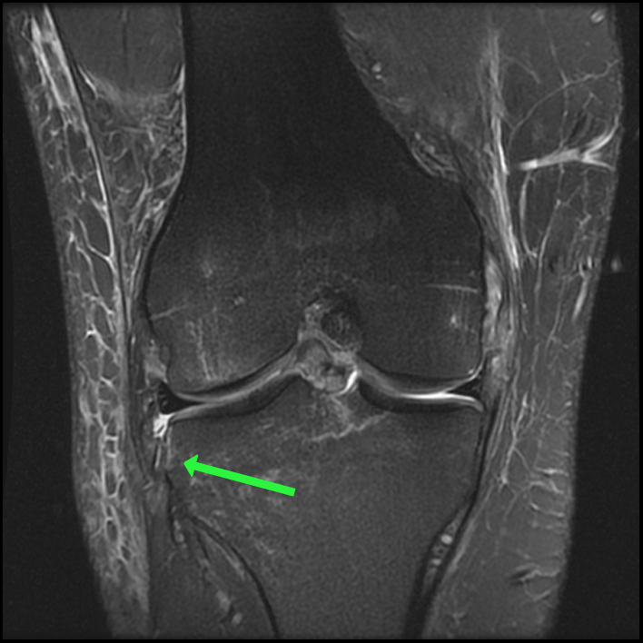 Segond Fracture - ProScan Education