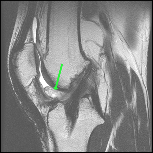 Cyclops Lesion - Proscan Education