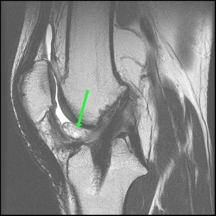 Cyclops Lesion - ProScan Education