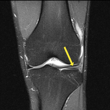 coronal pd spir