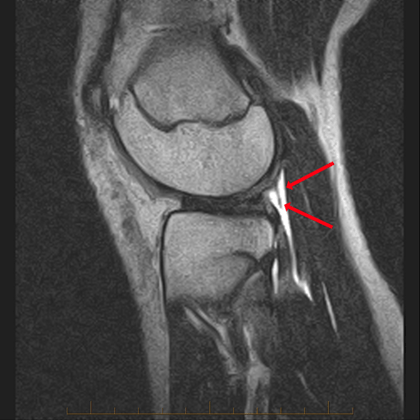 Arcuate Ligament - ProScan Education