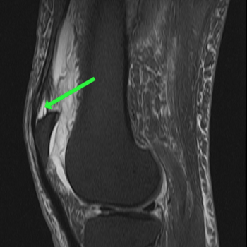 sagittal t2 fs