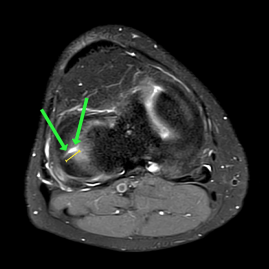 Parrot Beak Tear - ProScan Education