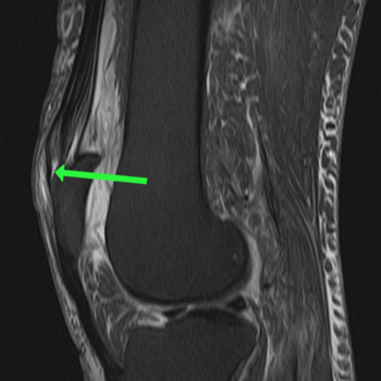 sagittal t2 fs