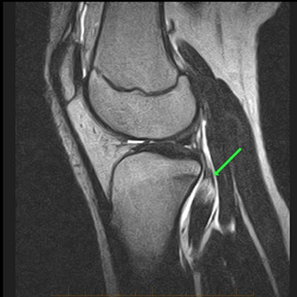 Arcuate Ligament - Proscan Education