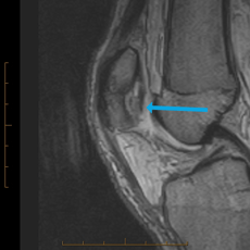 sagittal t2