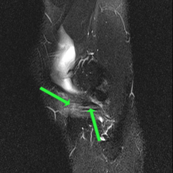 sagittal t2 spir