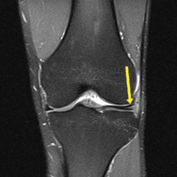 coronal pd spri