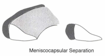 meniscocapsular separation