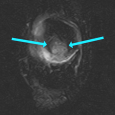 coronal stir