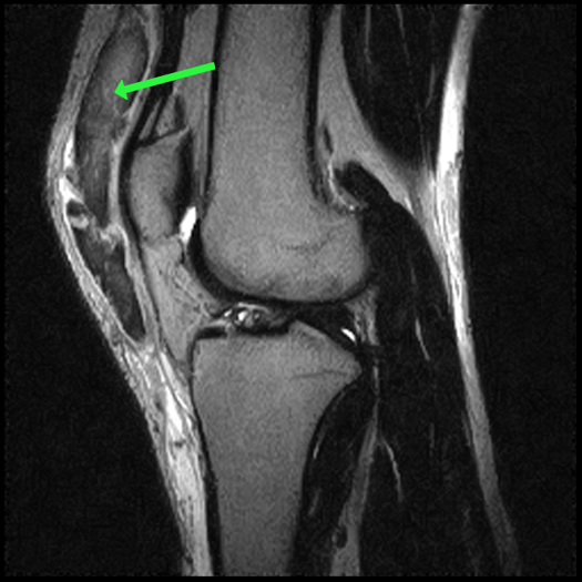 Morel-Lavallée Lesion - ProScan Education