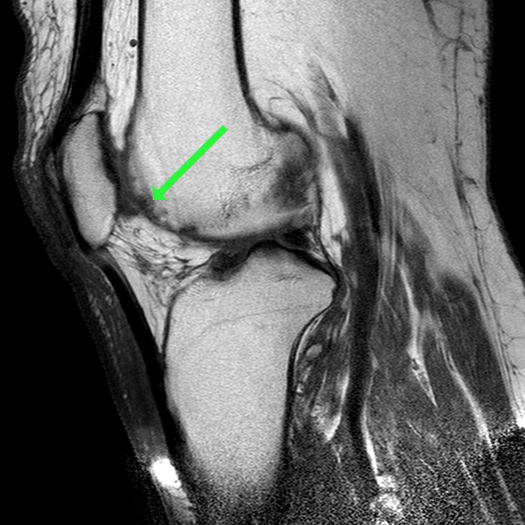 Patellofemoral Chondromalacia - Proscan Education