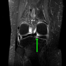 coronal t2 spir