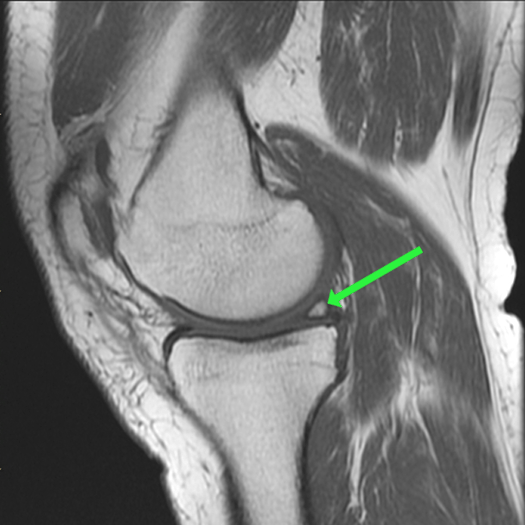 Meniscal Ossicle - ProScan Education