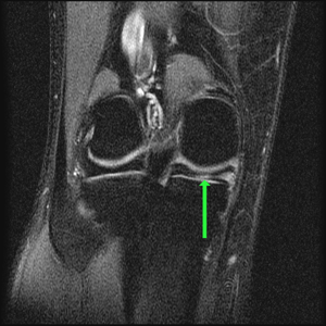 coronal pd fat sat