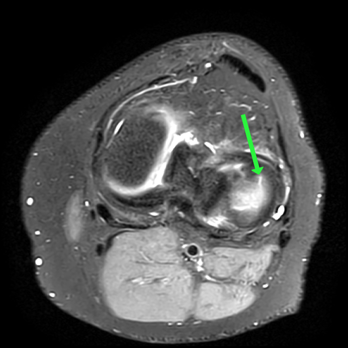 Radial Meniscal Tear - ProScan Education