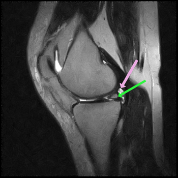 pd t2 sagittal