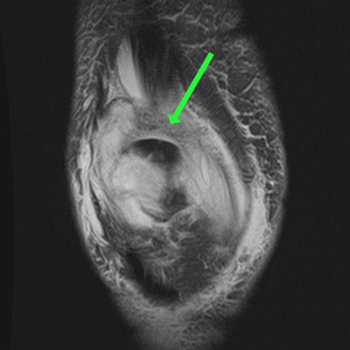 coronal t2 fs