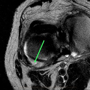 axial t2w tse