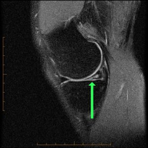 sagittal pd fat sat