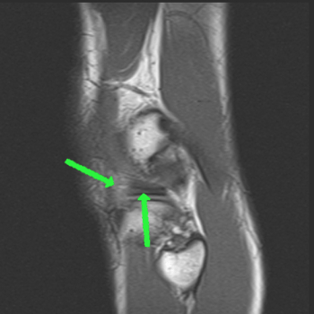 sagittal t1