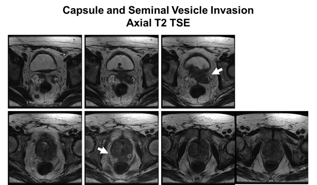 Prostate MRI Reference Guide - PI-RADS Version 2